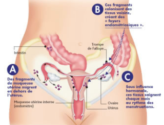 L’endométriose