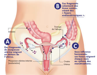 L’endométriose