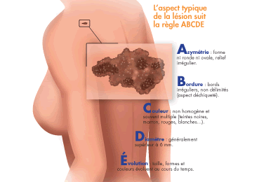 Le mélanome cutané