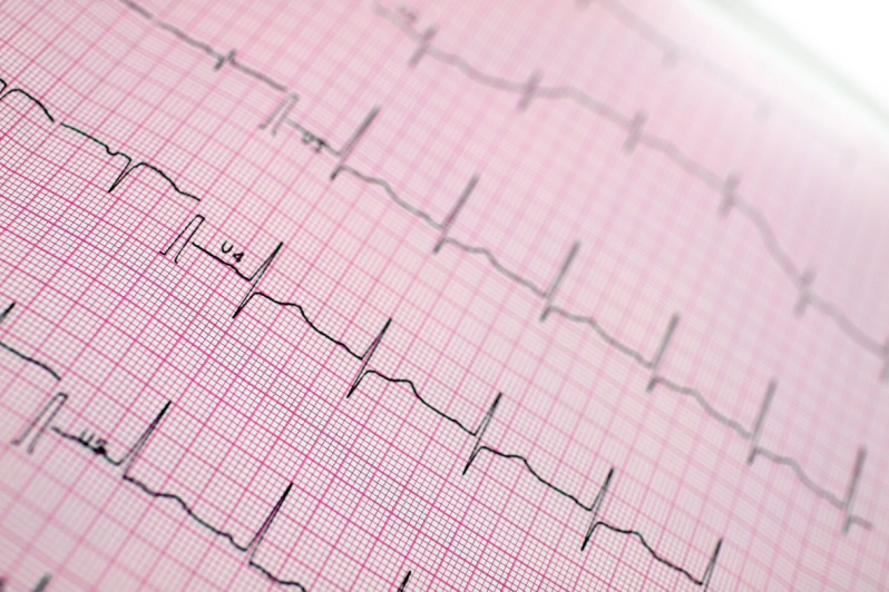 Insuffisance cardiaque : mortalité en baisse de 30 % en 10 ans