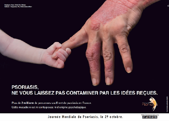 Psoriasis : journée mondiale le 29 octobre