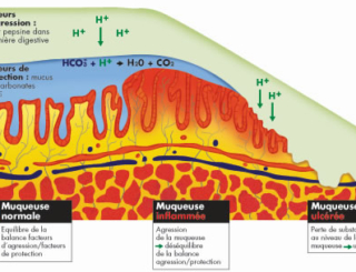 Savoir la patho : L’ulcère gastroduodénal