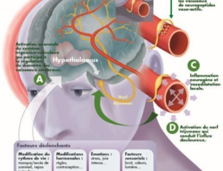 La migraine de l’adulte