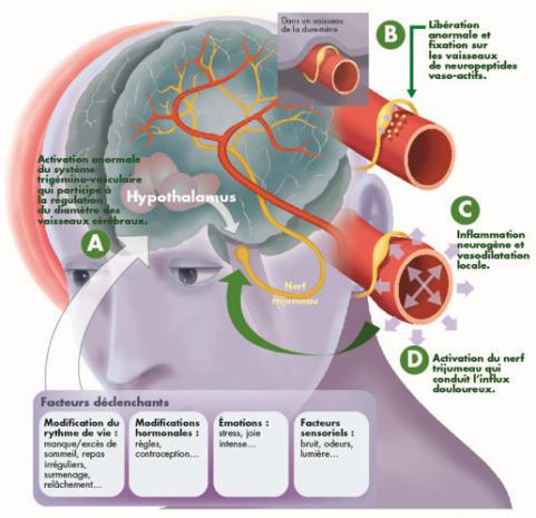 La migraine de l’adulte