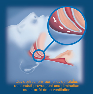 Le syndrome d’apnée du sommeil