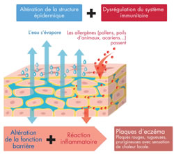 La dermatite atopique de l’enfant