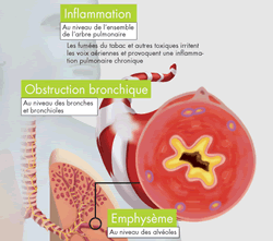 La bronchopneumopathie chronique obstructive