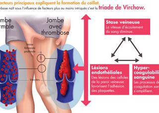 Patho : la thrombose veineuse profonde