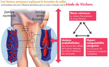 Patho : la thrombose veineuse profonde