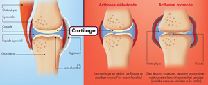 L’arthrose