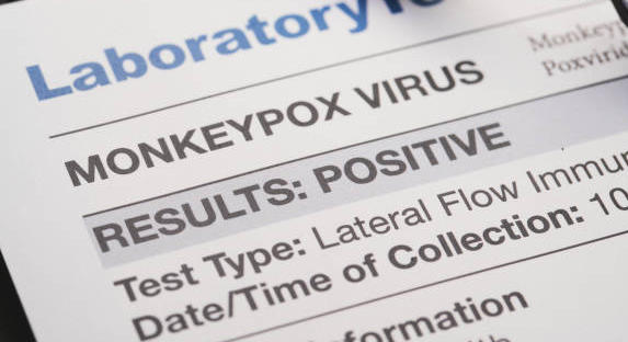 Monkeypox : vers un remboursement des tests ?