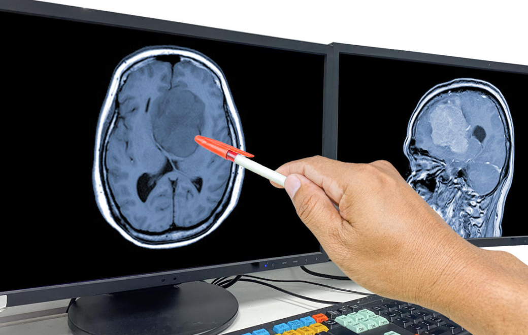 Progestatifs et méningiome : 3 nouvelles molécules incriminées et 3 autres innocentées​​​​​​