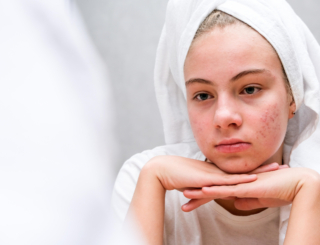 Acné : accompagner les ados avec un plan d’attaque ciblé