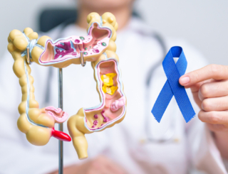 Cancer colorectal : identifier les risques pour mieux prévenir