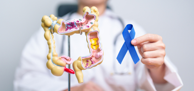 Cancer colorectal : identifier les risques pour mieux prévenir