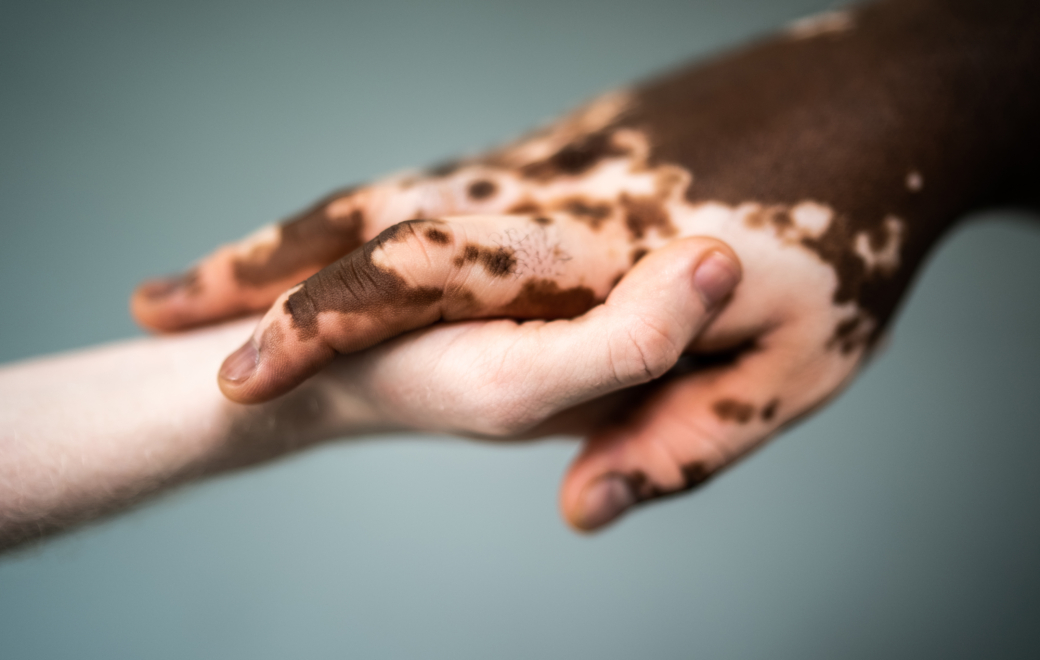 Vitiligo : comprendre la maladie