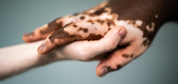 Vitiligo : comprendre la maladie